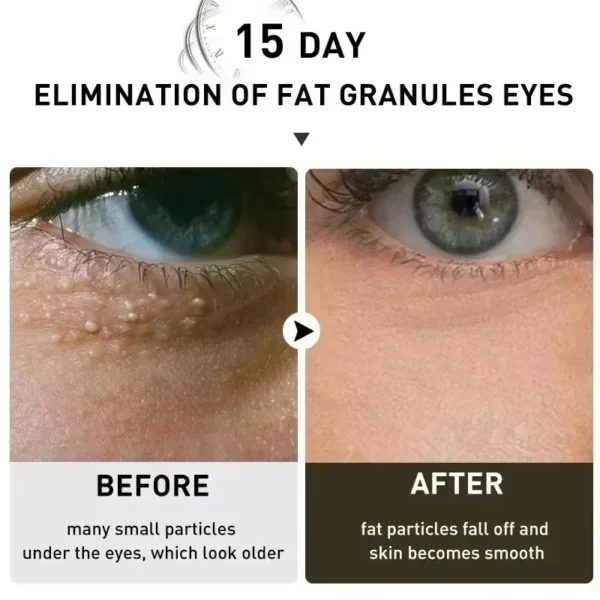 Dissolvant De Granulés De Graisse Oculaire – Image 3